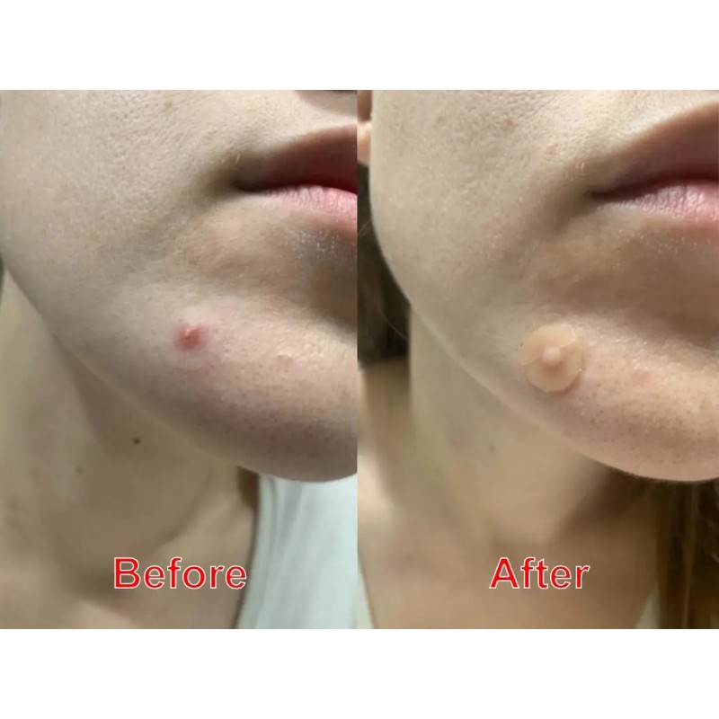 Acne Patches Supplier - OEM 36 Count Colorful Hydrocolloid Spot Treatment Skin