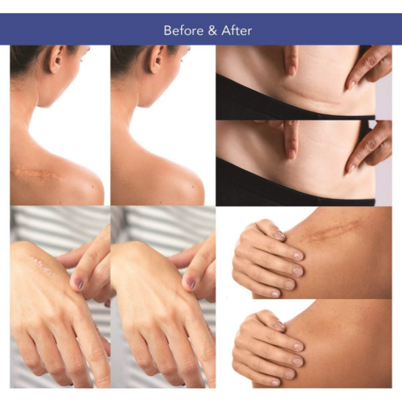 Silicone Patches Manufacturer - Private Label Silicone Belly Eye Patches Reusable