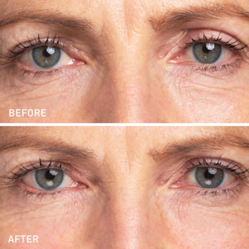 Eye Patches Supplier - Vitamin C Hyaluronic Acid Microneedle Dark Circles Relief