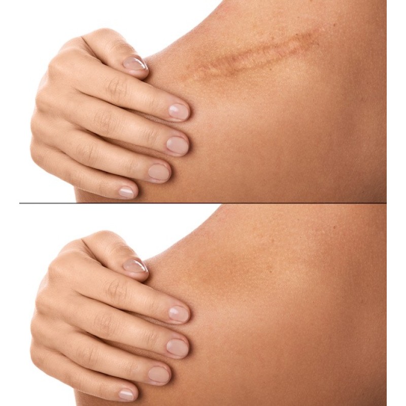 Silicone Patches Manufacturer - Private Label Silicone Belly Eye Patches Reusable