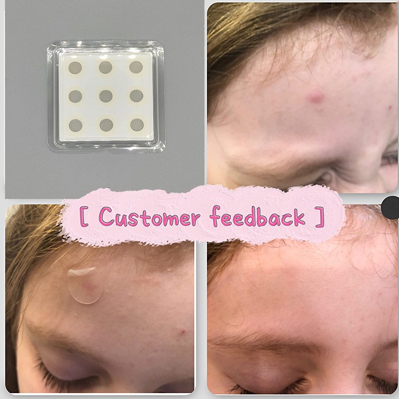 Acne Patch Supplier - Private Label Hyaluronic Acid Dissolving Nano Microneedle