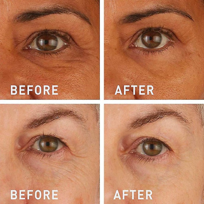 Microneedle Patches Manufacturer - Private Label Retinol Forehead Eye Anti Wrinkle