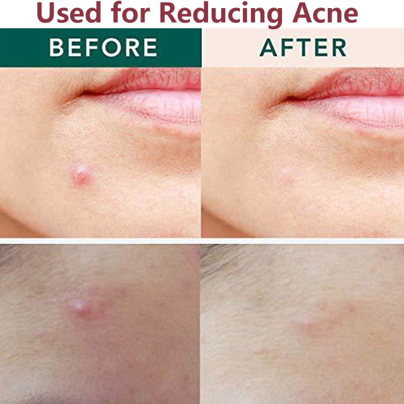 Acne Patches Manufacturer - Invisible Hydrocolloid Spot Healing Round Microneedle