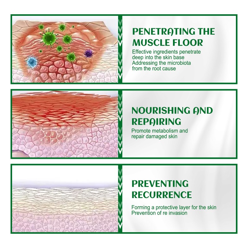 Acne Cream Factory - Anti Acne Follicles Clean