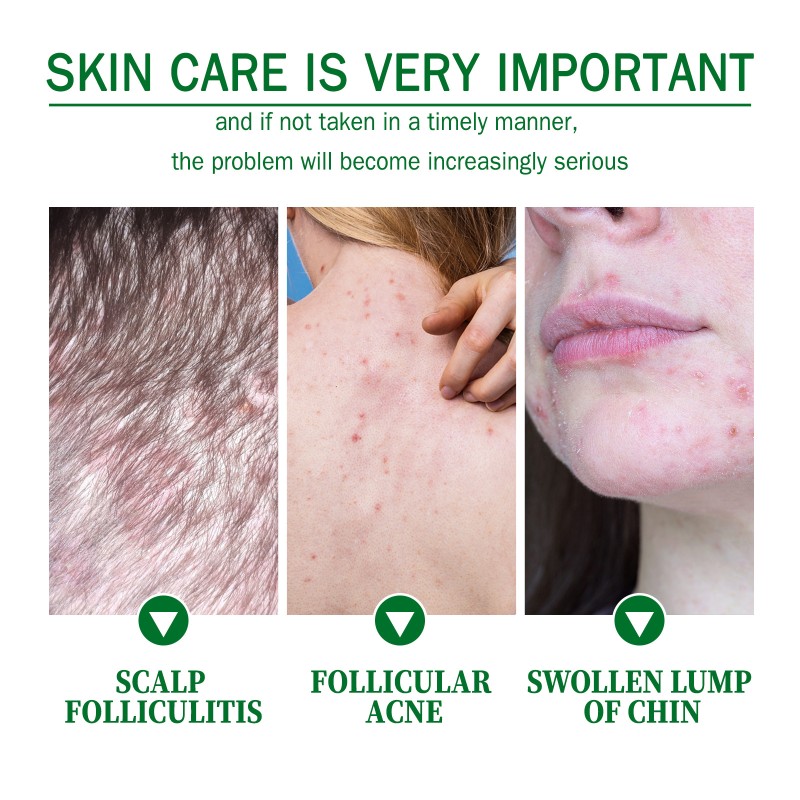 Acne Cream Factory - Anti Acne Follicles Clean