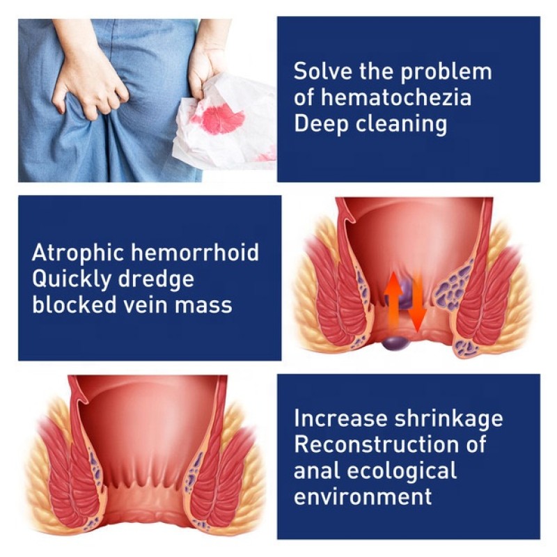 Hemorrhoid Cream Supplier - Anus Repair Cream Mixed Formula