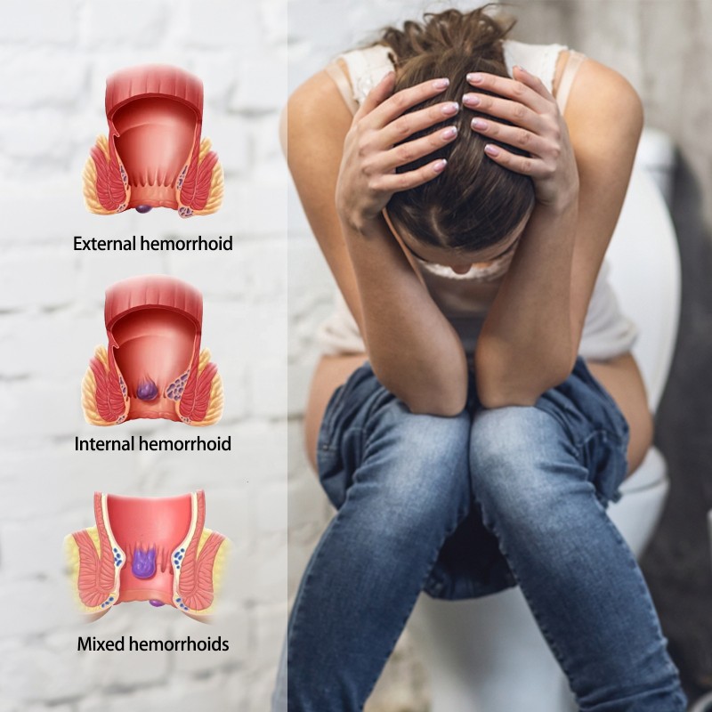 Hemorrhoid Relieving Cream Manufacturer - Anal Swelling Itching