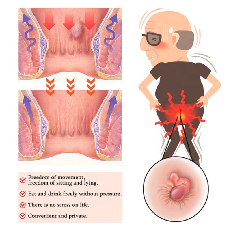 Hemorrhoid Cream Supplier - Anus Repair Cream Mixed Formula