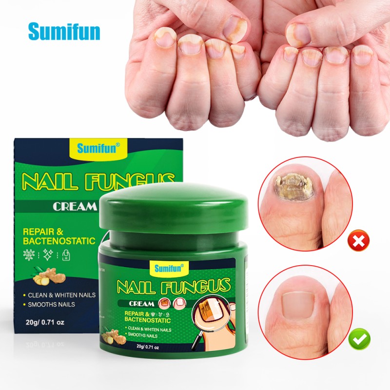 Nail Fungus Cream Supplier - Foot Fungal Treatment
