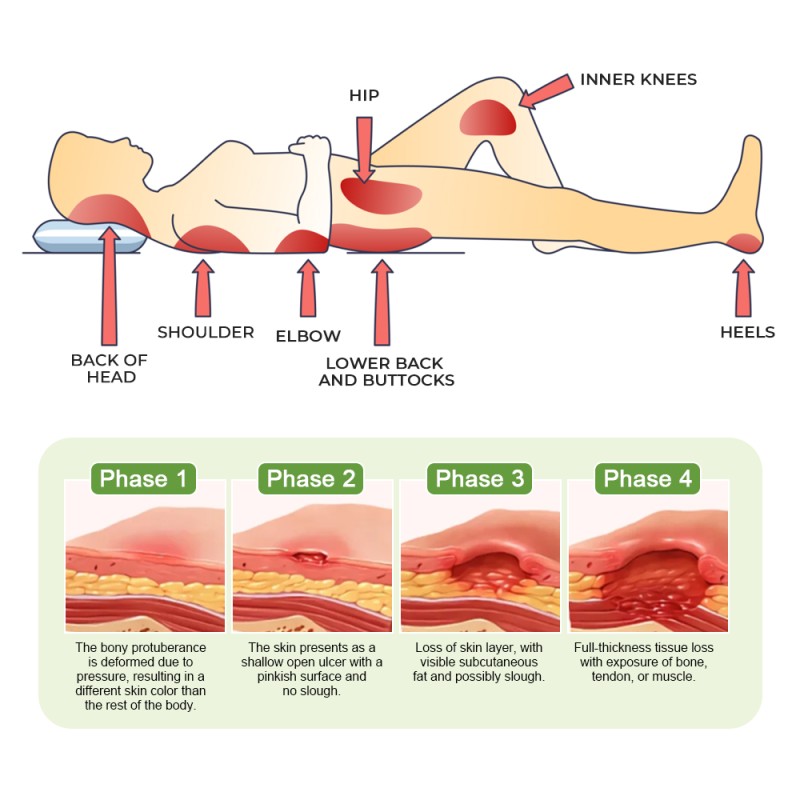 Bedsore Cream Manufacturer - Ultra-Gentle Soothe Care