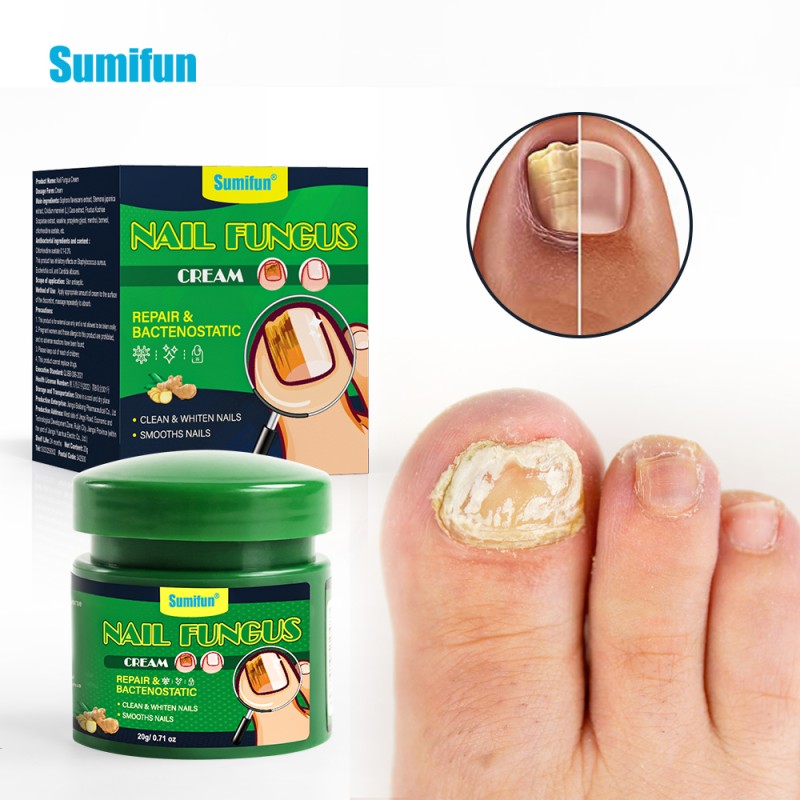 Nail Fungus Cream Supplier - Foot Fungal Treatment