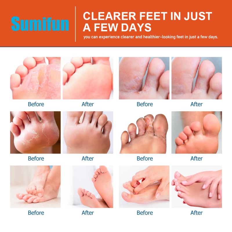 Anti-Fungal Spray Manufacturer - Herbal Deodorant Powder