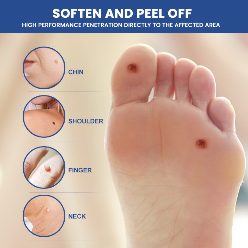 Wart Removal Gel Factory - Fast Acting Face Foot Hands
