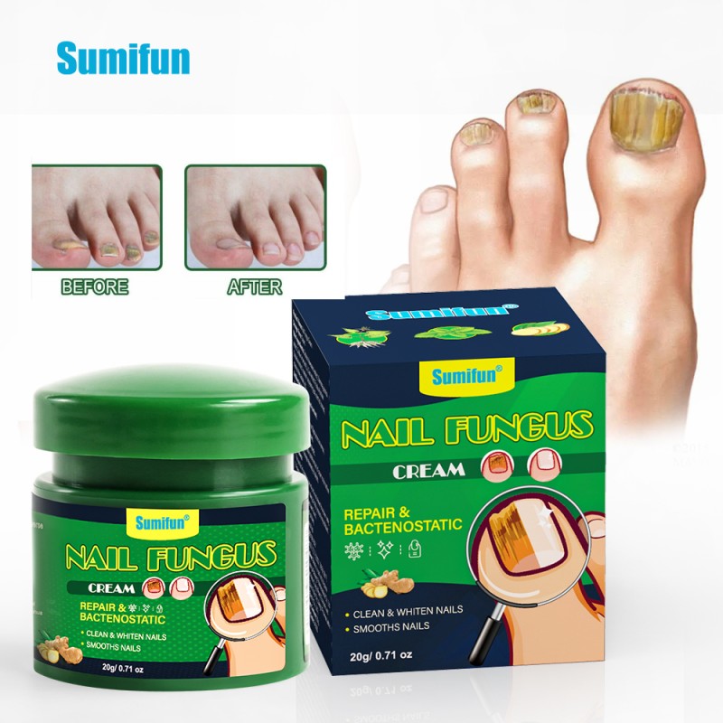 Nail Fungus Cream Supplier - Foot Fungal Treatment