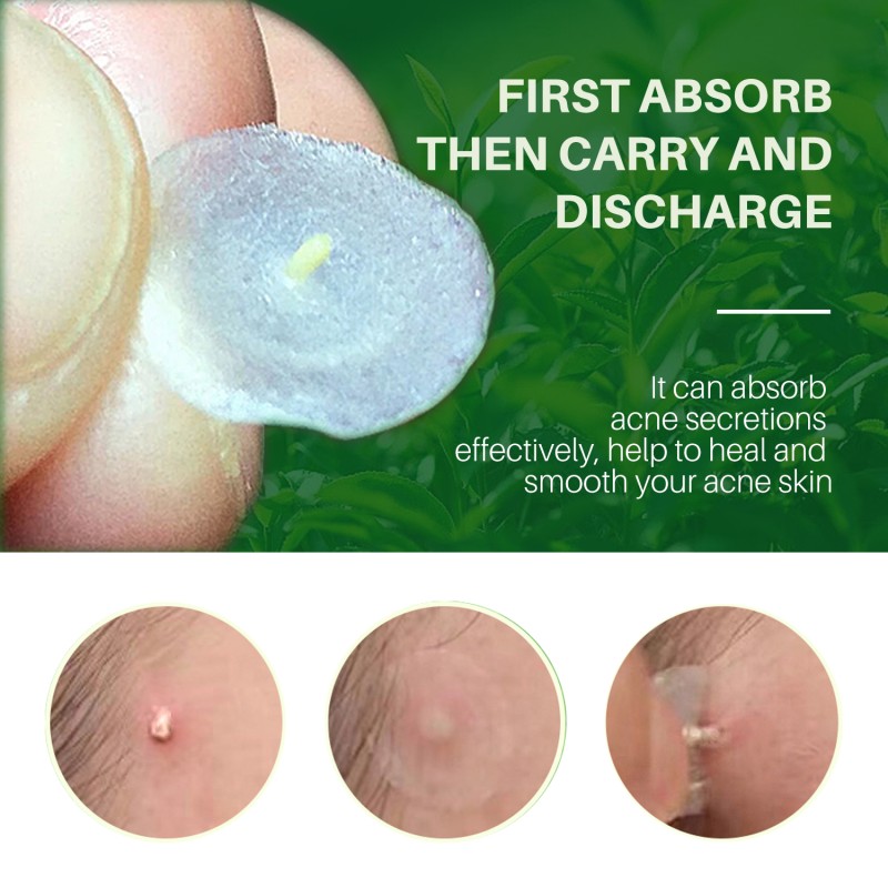 Acne Free Patch Supplier - 72 Pieces Facial Skin Care