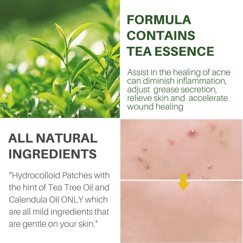 Acne Free Patch Supplier - 72 Pieces Facial Skin Care