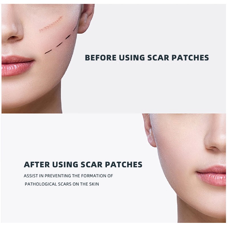 Medical Scar Tape Supplier - Keloid Cesarean Section Care