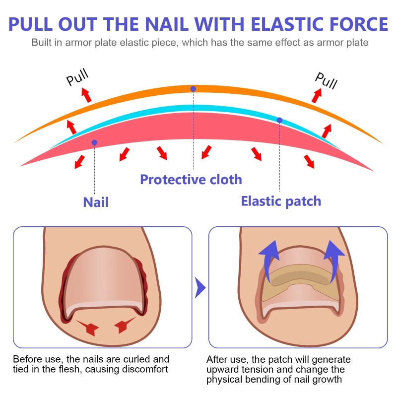 Nail Treatment Patch Factory - Anti Fungal Ingrown Toenail