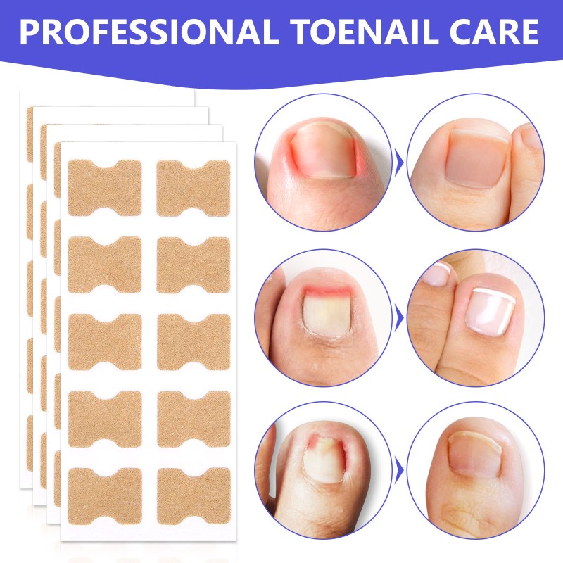 Nail Treatment Patch Factory - Anti Fungal Ingrown Toenail