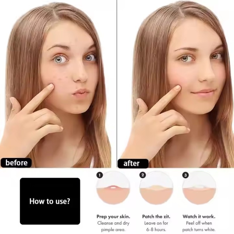 Hydrocolloid Acne Patch Factory - Transparent Pimple Treatment
