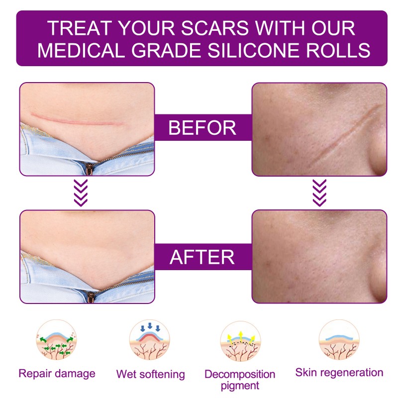 Silicone Scar Sheets Factory - Facial Belly Leg Removal