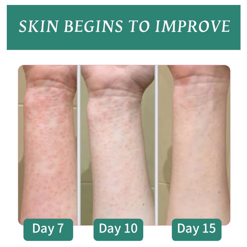 Eczema Cream Supplier - Chinese Herbal Skin Itching