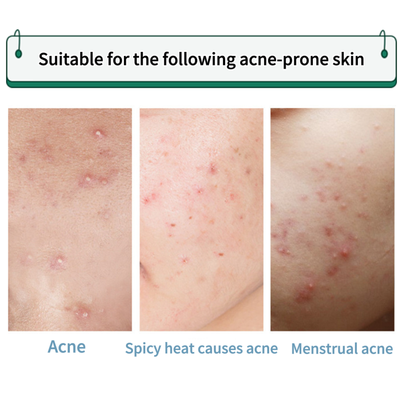 Hydrocolloid Acne Patch Supplier - Various Colors Sizes Star