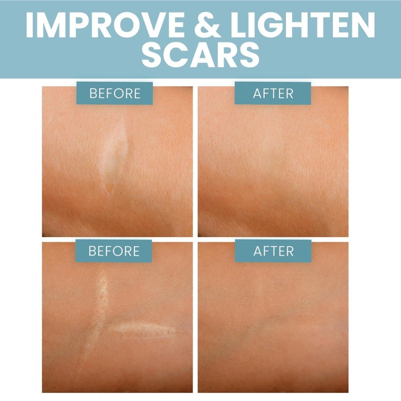 Beauty Scar Patch Factory - Skin Tone Hyperplastic Cover