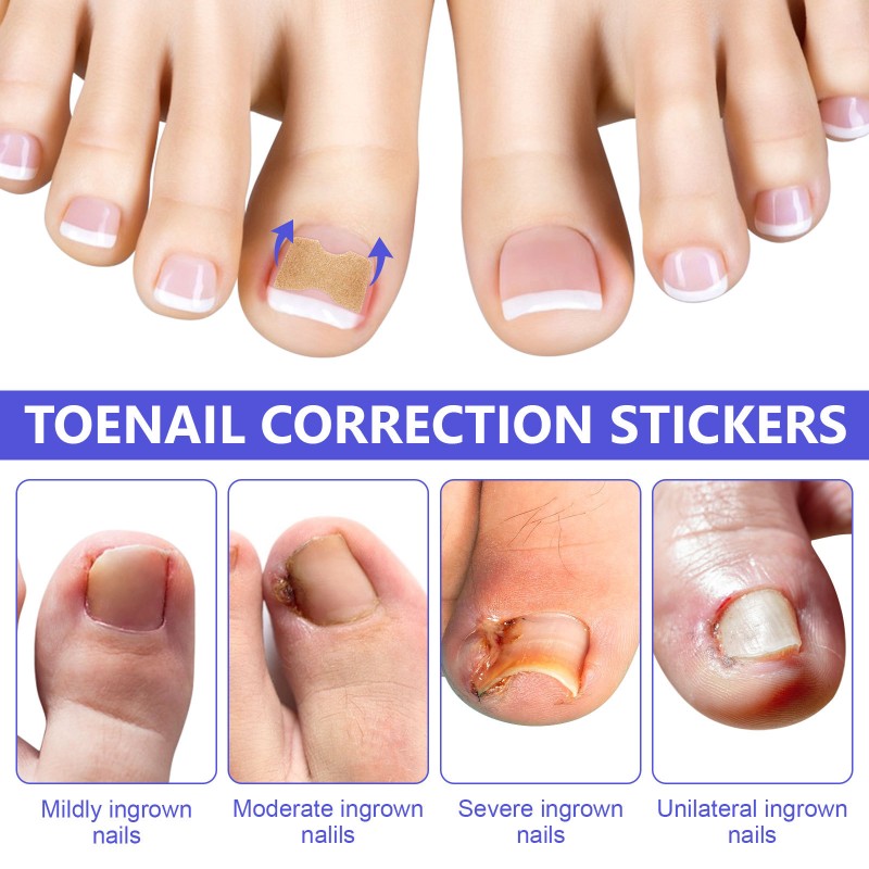 Nail Treatment Patch Factory - Anti Fungal Ingrown Toenail