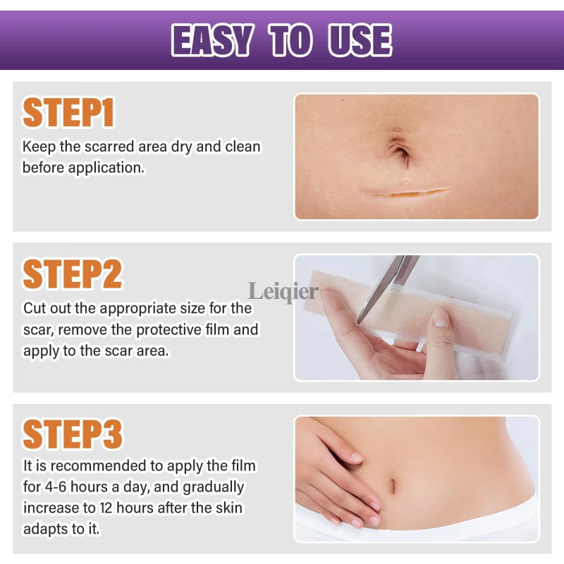 Silicone Gel Patch Supplier - Invisible Stretch Mark Cover