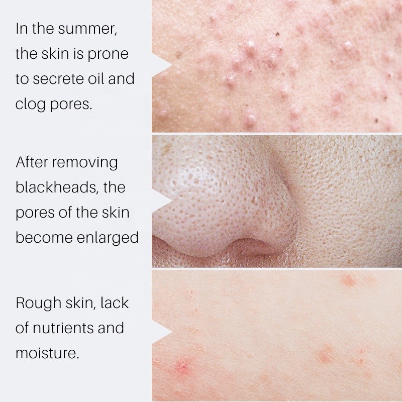 Customized Private Label 10ml Blackhead Removal Tightens Skin Pore Shrinking Serum for Skin Care
