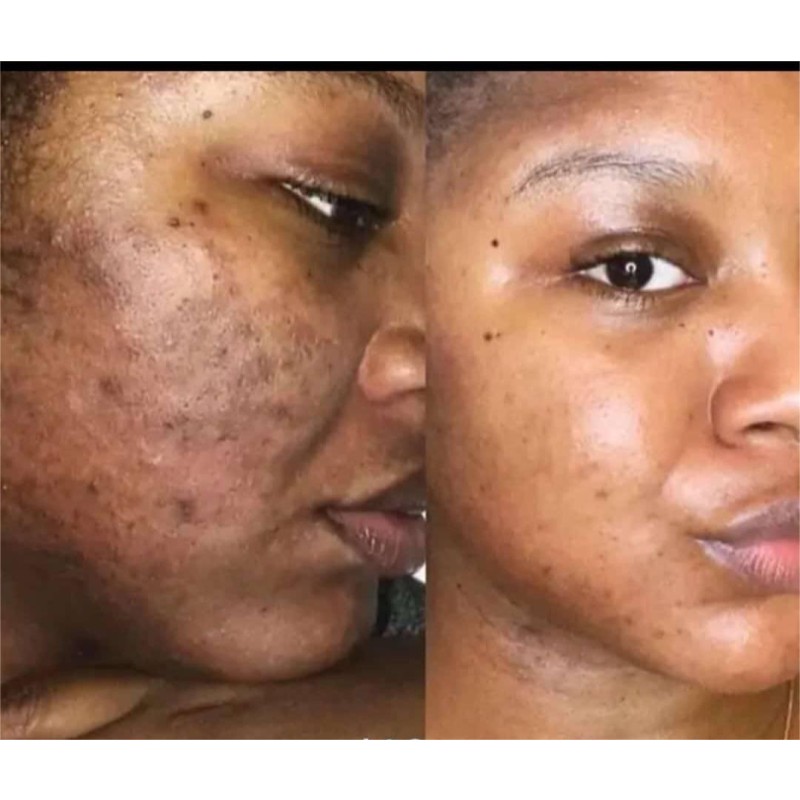 Cheap Factory Price Herbal Whitening Private Label Face Acne Treatment Turmeric Soap