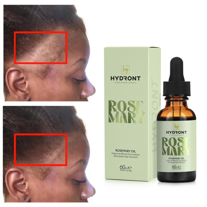OEM ODM Natural Organic Vegan Rosemary Hair Growth Oil Fast Acting Hair Serum for Black Women for Home Use