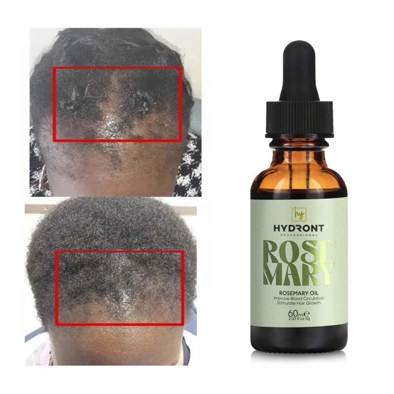 100% Pure Rosemary Oil Hair Growth Products for Man Women Anti Hair Loss Fast Regrowth Thicken Oil