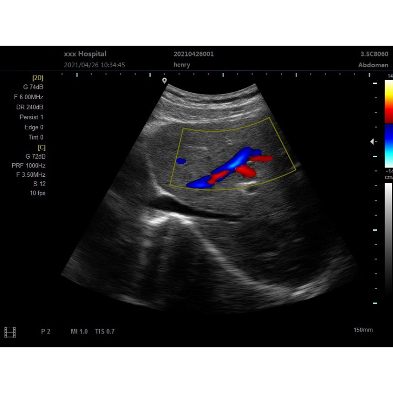 Color Doppler Ultrasound Supplier - C2 Laptop Portable