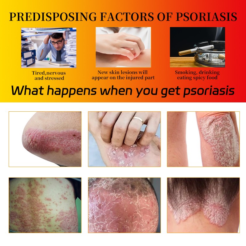 Antifungal Ointment Manufacturer - Sulfur Mite Cream