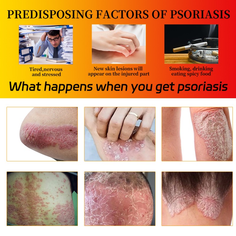 Anti-Itch Cream Supplier - Pruritus Eczema