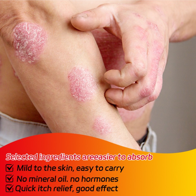 Eczema Cream Manufacturer - New Hot Selling