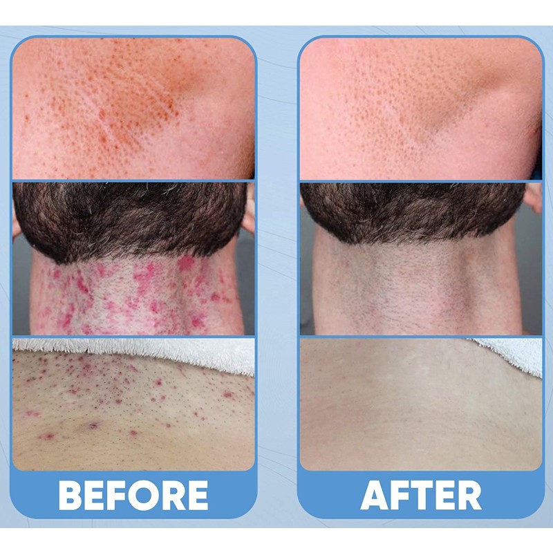 Ingrown Hair Spray Supplier - Prevention Treatment