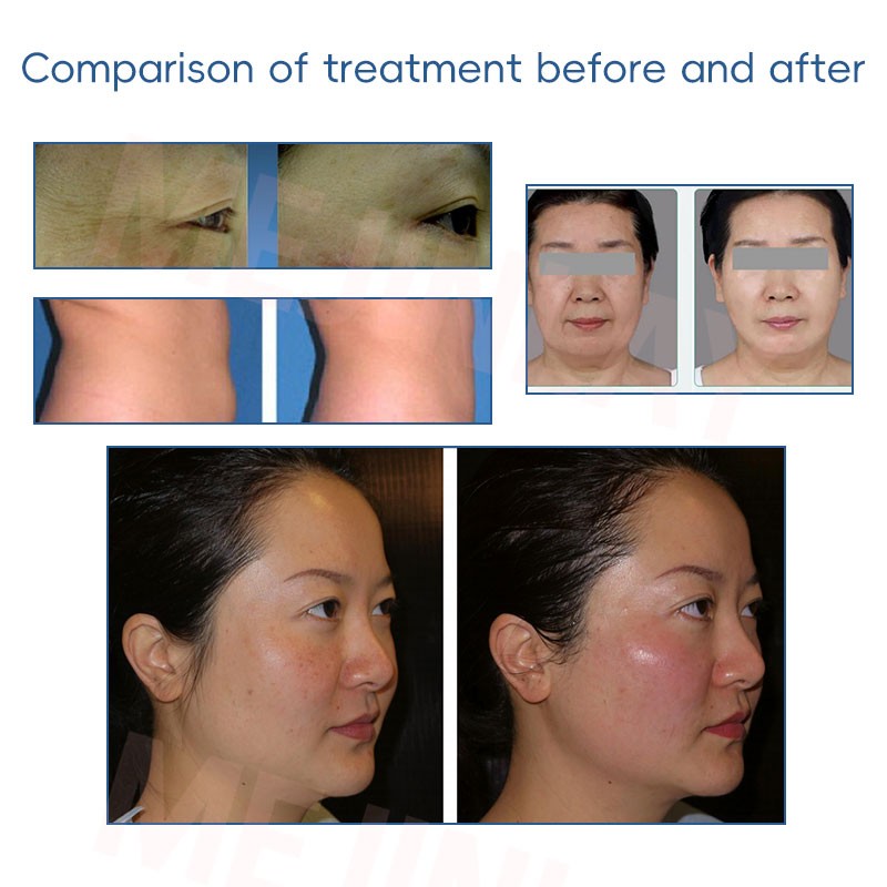 EMRF Facial Device Factory - 6 Pads Double Chin Removal