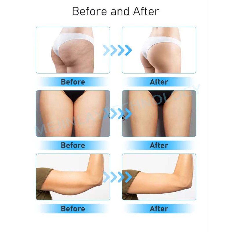 EMS Slimming Belt Supplier - Belly Fat Removal Custom