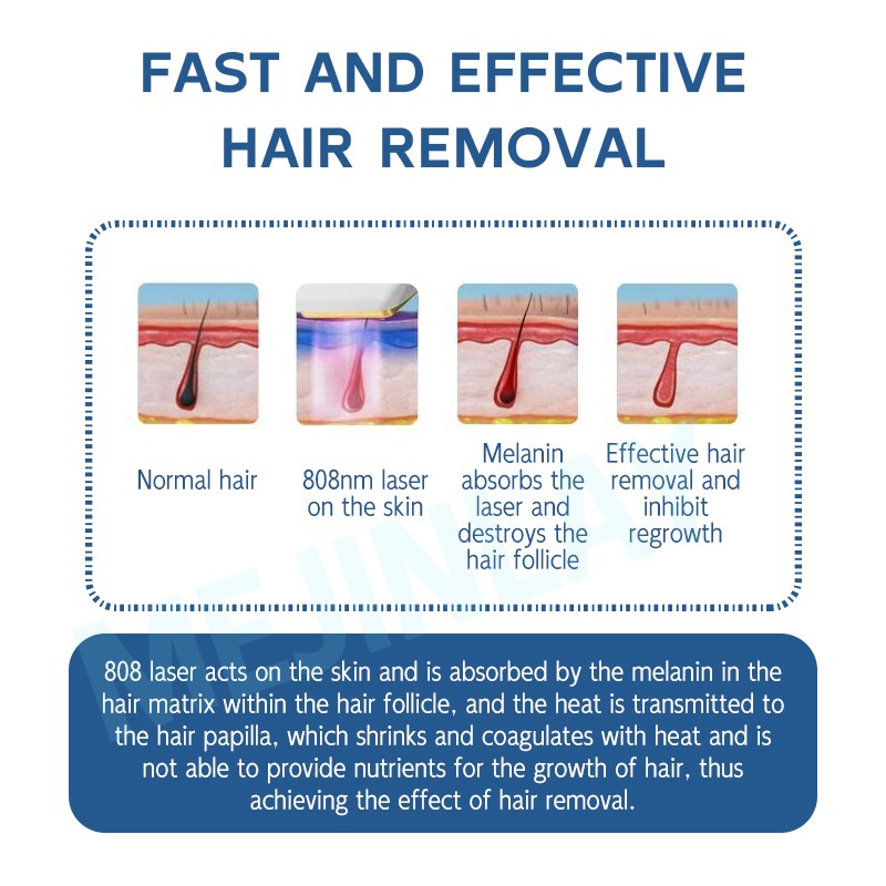 Permanent Hair Removal Factory - Diode Laser Painless