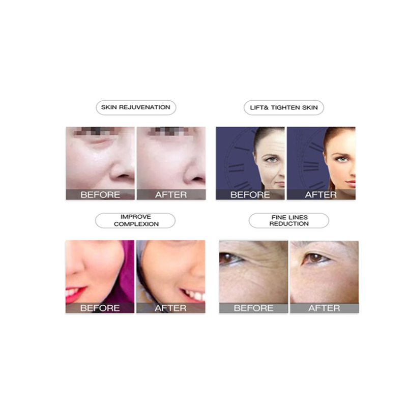 Portable Mesotherapy Factory - No Needle RF Skin Machine