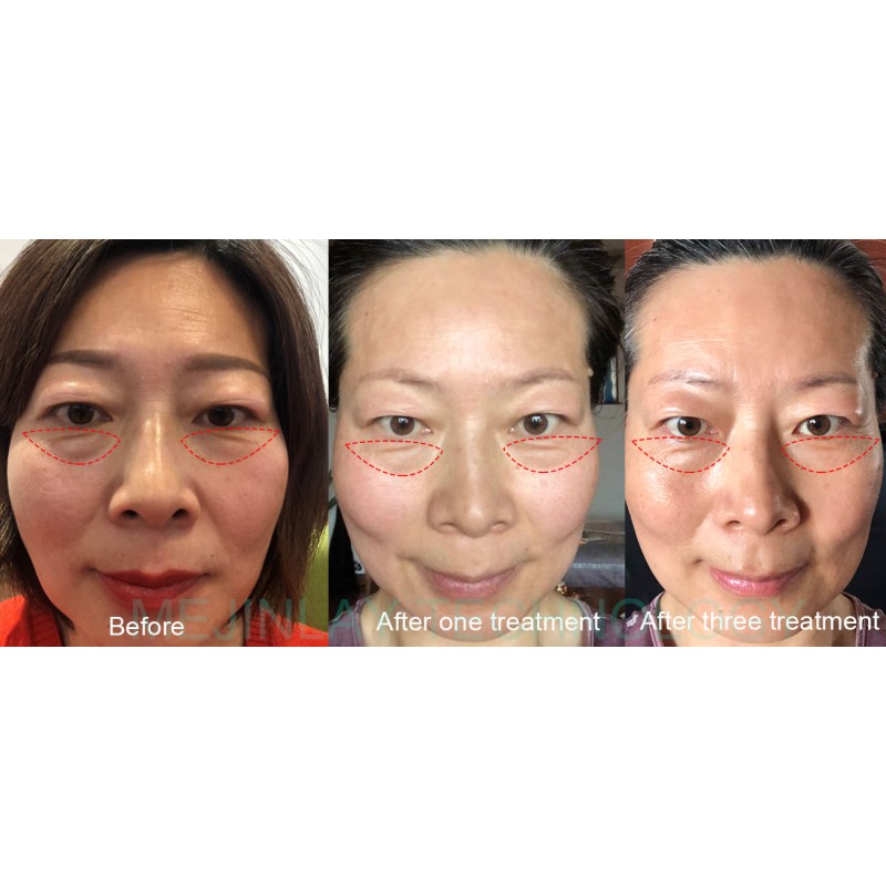 Tripolar RF Device Factory - Deep Wrinkle Face Lifting