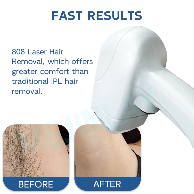 Permanent Hair Removal Factory - Diode Laser Painless