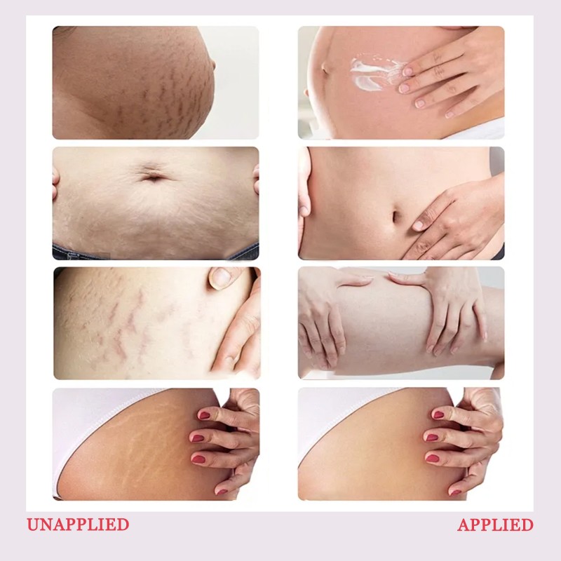 OEM Herbal Stretch Mark Cream Whitening Natural  Antipruritic Smooth Body Butter Lotion Body Cream for Skin Care