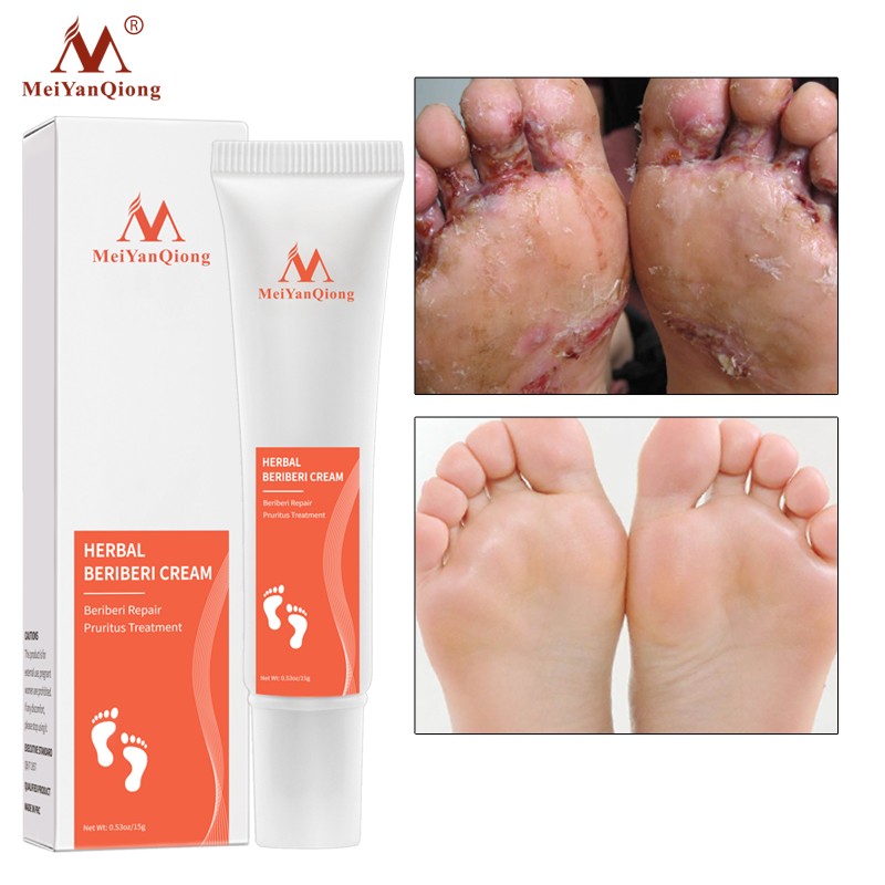 Foot Scrub Supplier - Herbal Anti Fungal