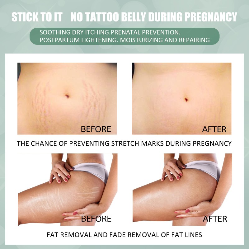 Stretch Mark Cream Factory - Pregnancy Repair