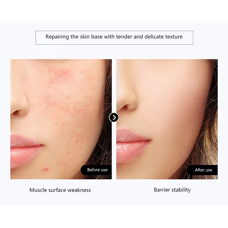 Gypsum Face Mask Factory - V Shape Lifting Custom