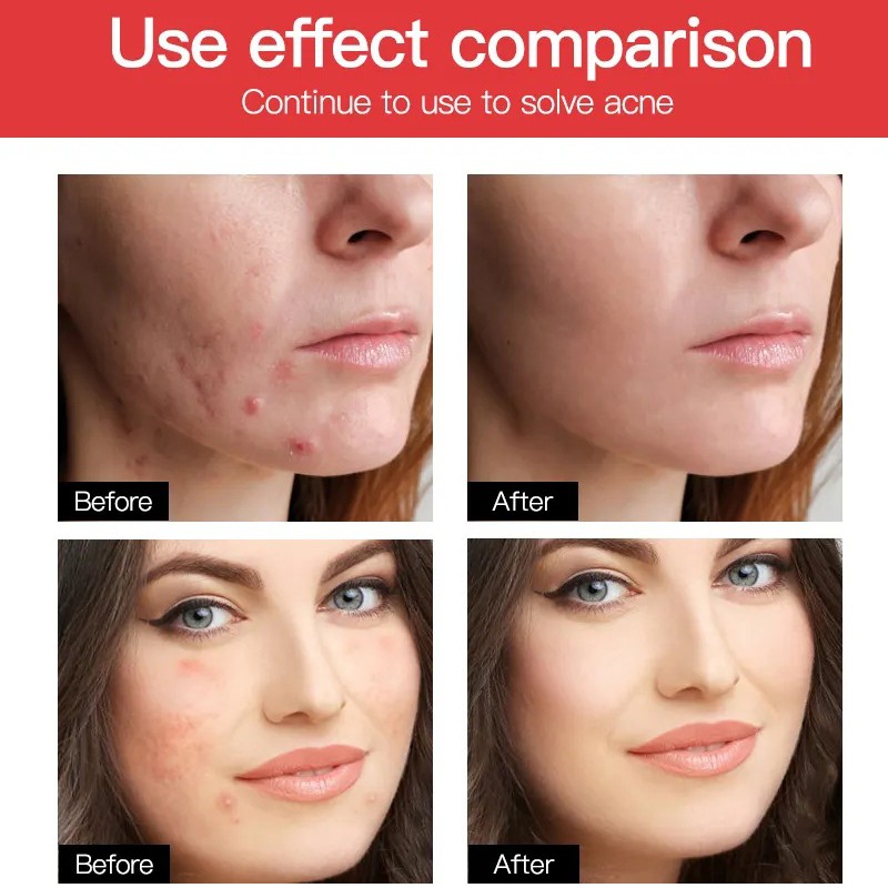 Acne Patches Manufacturer - OEM Custom Invisible Repair